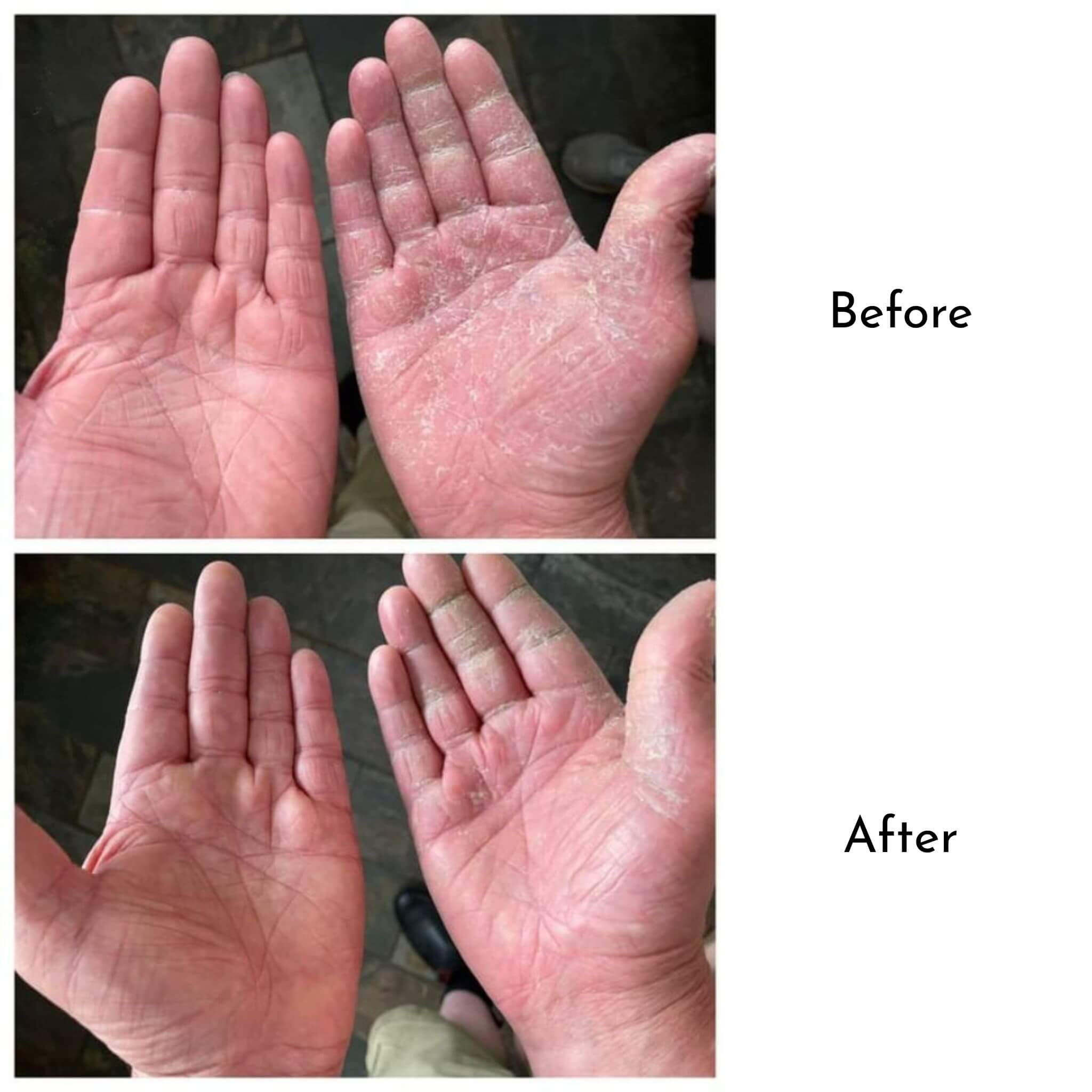 Blossom and Hive Honey Butter Balm before and after photos showing a dry palm healed after using Honey Butter Balm